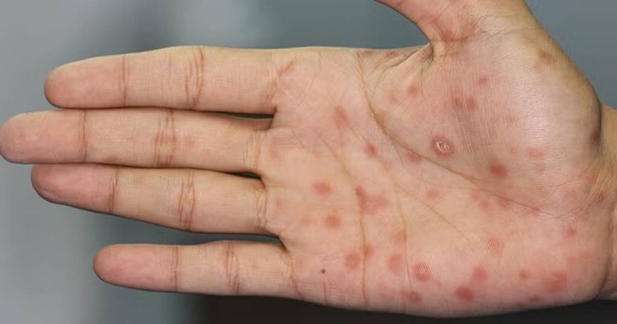 Alerta sífilis: los casos se incrementaron un 20,5% en Argentina