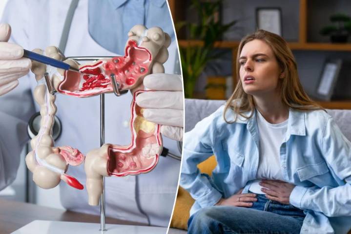 These foods may be fueling colorectal cancer in young women