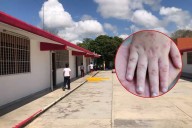 Cancelan clases en Calderitas por Coxsackie: Van 79 casos confirmados hasta ahora