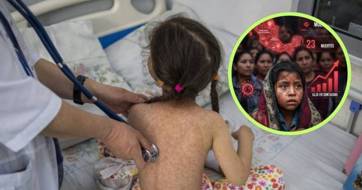 México confirma alza de sarampión: 78 casos más y 23 muertes, ¿qué estados están en riesgo?