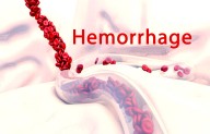 Risk of first intracranial hemorrhage risk in unruptured brain AVMs lower than anticipated: JAMA