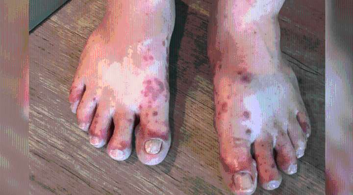Hand, foot and mouth disease cases on the rise in Mobile