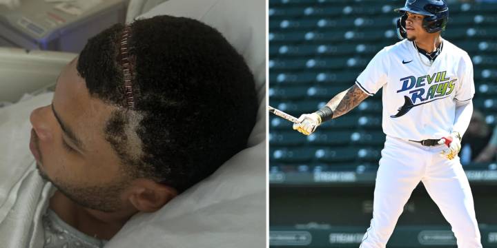 Xavier Isaac undergoes brain surgery