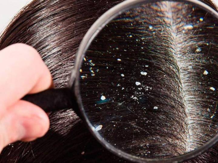 ¿Cómo evitar la caspa en temporada invernal?