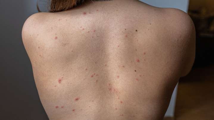 Los casos de sarna detectados en España se multiplican por 50 entre 2011 y 2023