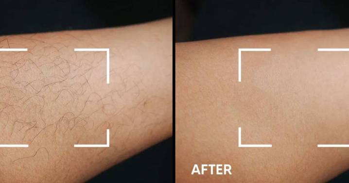 Shoppers say 'no more shaving every day' after 'best hair removal' device now £140 off