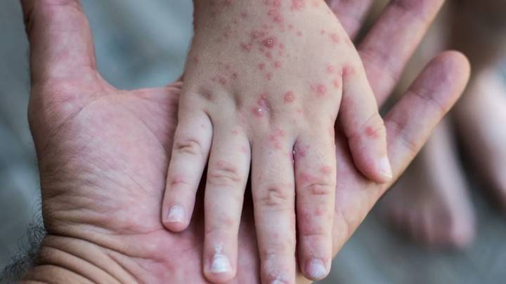 Esto sabemos de la primera víctima por sarampión en Jalisco: una bebé de 11 meses