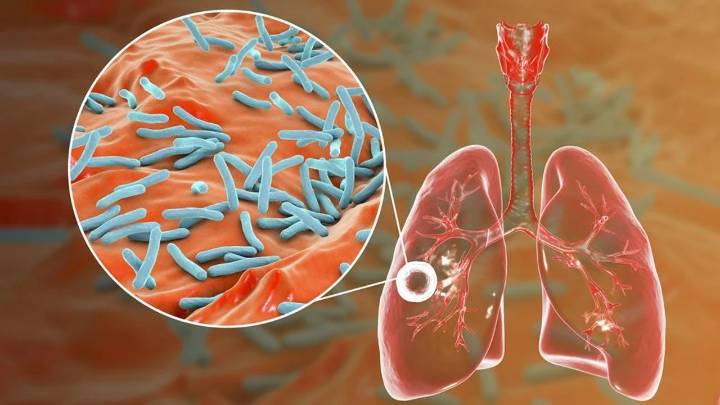 Alerta tuberculosis: se notificaron más de 13.000 casos en Argentina