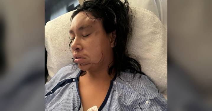 Dogs attack pregnant woman in Lame Deer