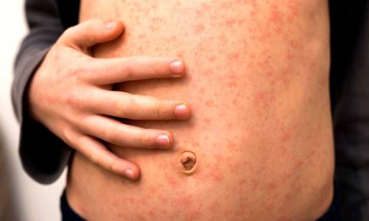 Canadá lleva 12 meses de casos de sarampión; pierde certificado como país libre de transmisión