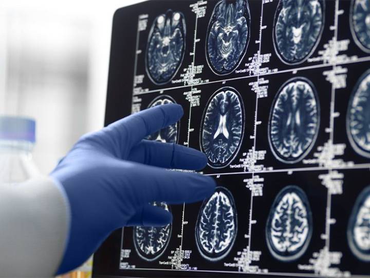 Dementia: Neurovascular, metabolic changes may predict progression