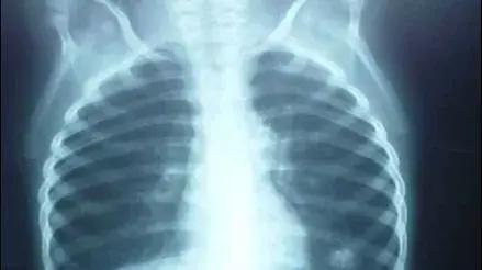 San Martín de Porres: paciente con TBC en los ganglios recibe tratamiento tras pedido de ayuda