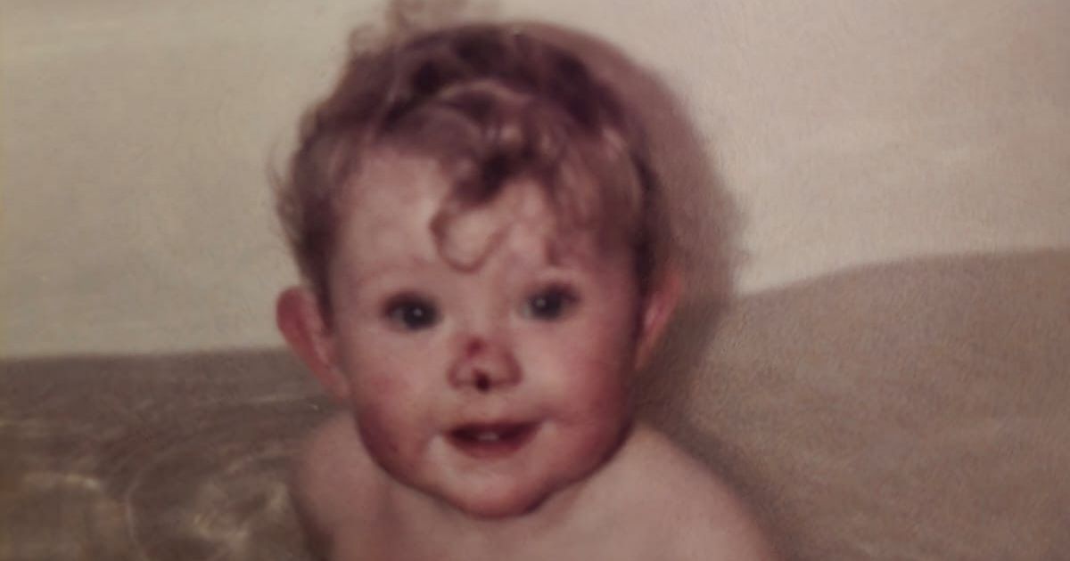 Scots mum's rare ‘butterfly skin’ wounds sparked child abuse fears