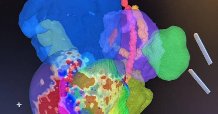 Première ablation réussie d’une TV ischémique chez l’homme réalisée dans un laboratoire iCMR