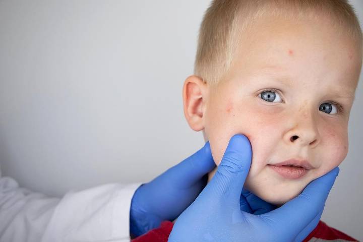 ACAAI: Eczema Onset, Severity Can Effect Child's Ability to Outgrow Food Allergy