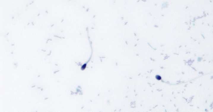 La IA logró el primer embarazo en caso de infertilidad masculina: identificó los espermatozoides sanos