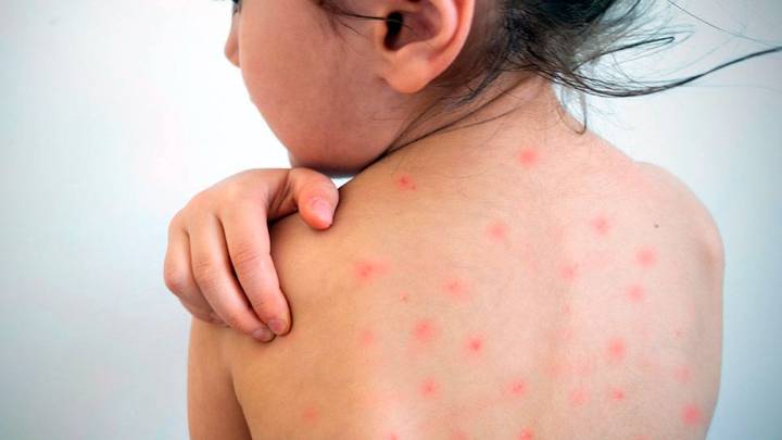 Nuevo brote de sarampión en la Provincia: qué recaudos tomar