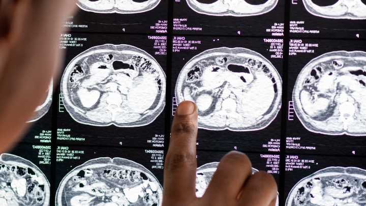 Científicos españoles descubren una enfermedad neurológica que afecta solo a 13 personas en el mundo