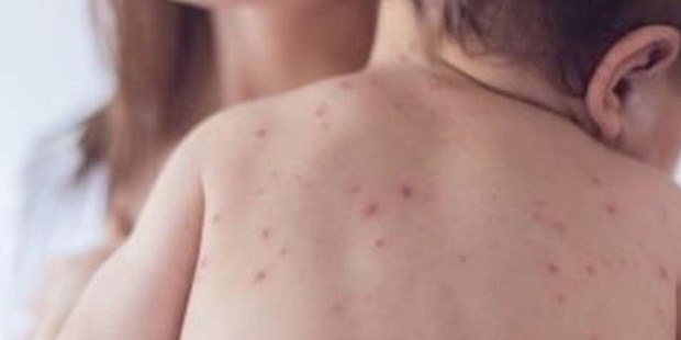 Alerta epidemiológica por nuevos casos de sarampión