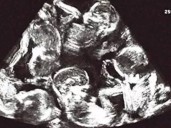 Sorpresa médica: una mujer descubrió que está embarazada de 9 bebés