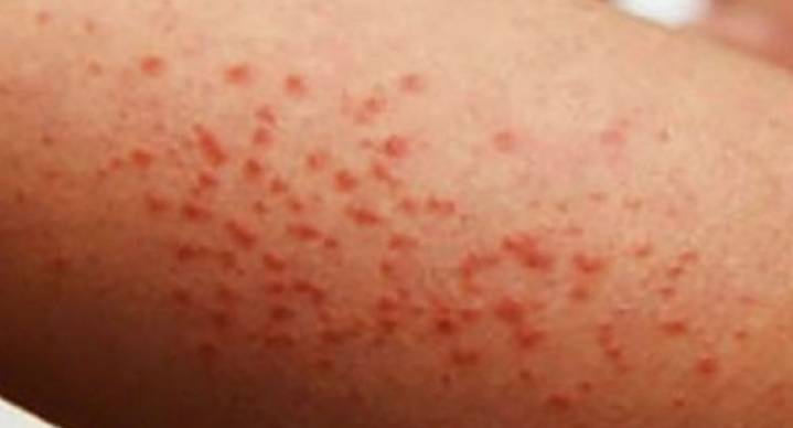 OPS advierte que persisten brotes de sarampión en México y América