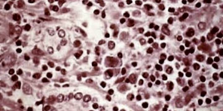 First Hantavirus case reported in Lyon County