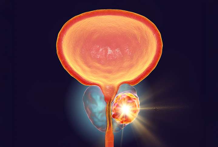 Thyroid Hormone Receptor TRβ Identified as New Target for Prostate Cancer Treatment