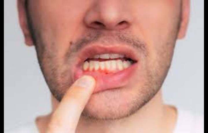 Antidepressant Use Linked to Reduced Prevalence of Periodontitis: Findings from Large
