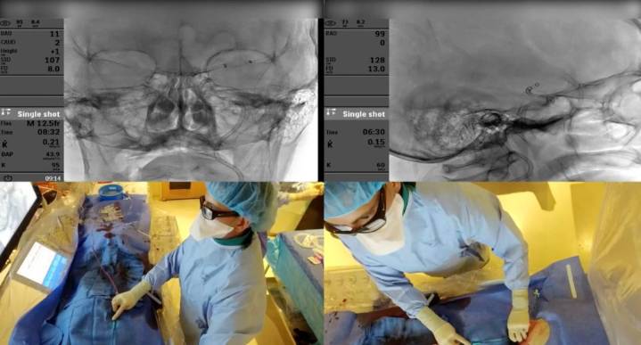 Memorial Broadcasts Neurointerventional Procedures To Global Audiences