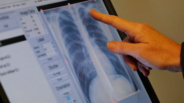 N.L. health authority reports tuberculosis outbreak in northern Labrador