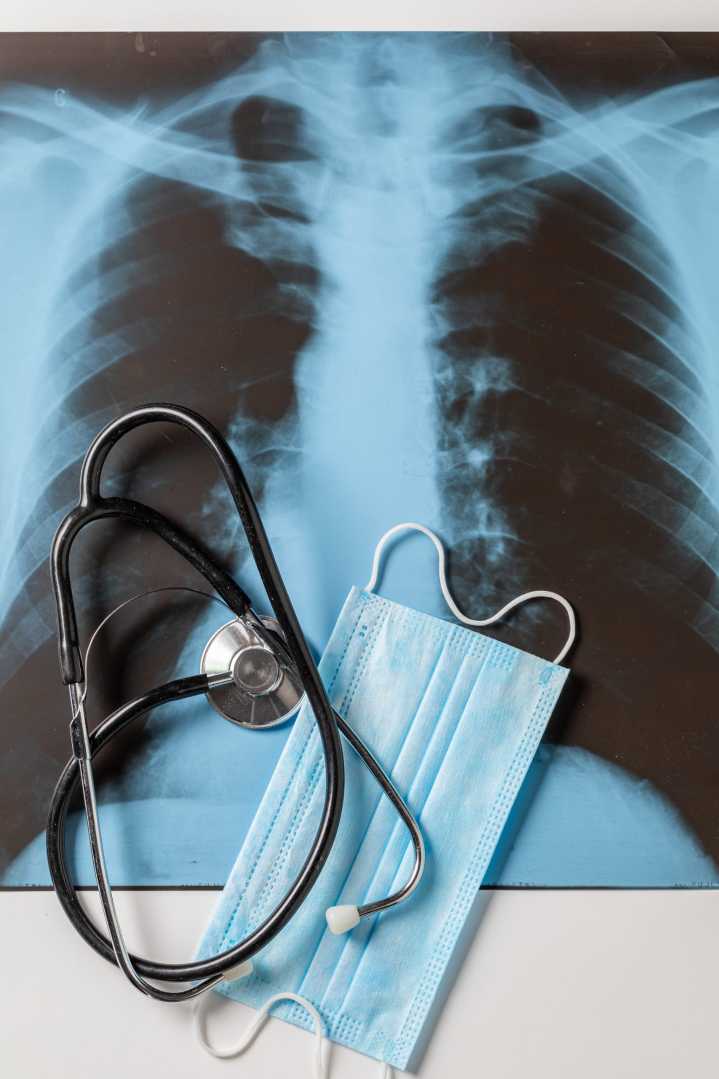 Cómo la IA ayuda a detectar el cáncer de pulmón