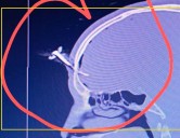 Apuñalado con una llave de auto en el cráneo durante una pelea