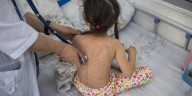 Sarampión en México: Salud reporta 74 casos activos en todo el país