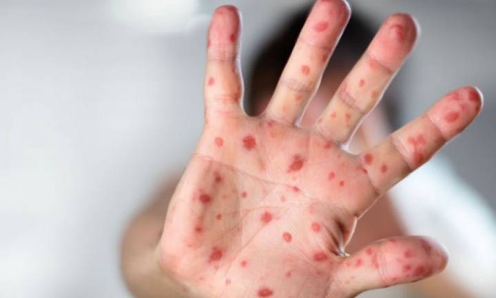 Sarampión: autoridades sanitarias instan a estar al día con el esquema de vacunaciones