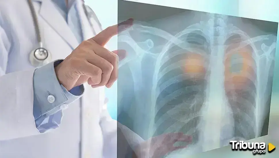 El cáncer de pulmón cambia de rostro: más casos en jóvenes y alarma por el aumento en mujeres no fumadoras