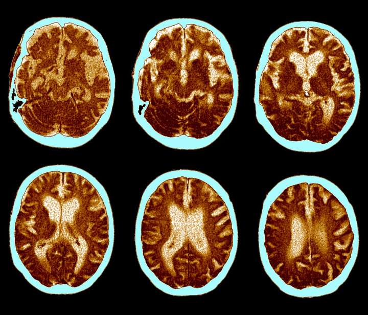 GLP-1 Pill Fails to Slow Alzheimer’s Progression in Clinical Trial