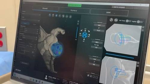 New medical technology at St. Agnes Medical Center helps ease severe shoulder pain