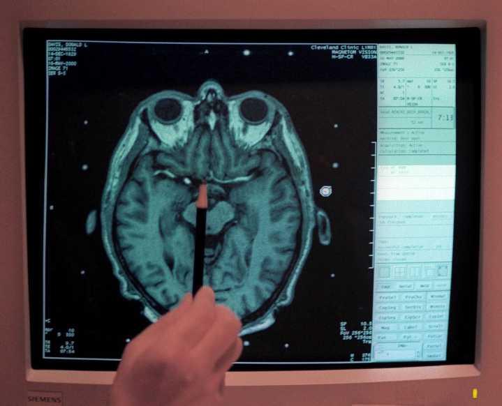 A charity offered free MRIs to screen for brain cancer. Doctors worry they’re not worth the risks