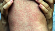 4 more measles cases confirmed in Manitoba