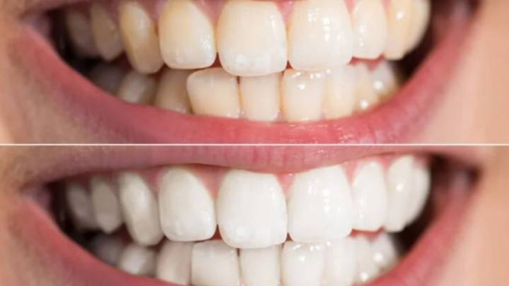 Así puedes eliminar el sarro de tus dientes; sin bicarbonato ni limón y sin ir al dentista