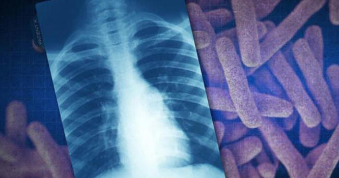 Global tuberculosis diagnoses rise to a record, but deaths fall, WHO reports