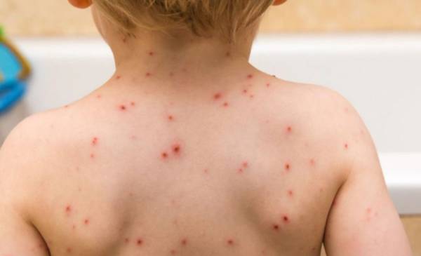 Un brote de sarampión enciende alarmas en la Provincia: los síntomas y cómo se contagia