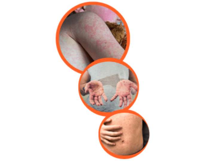 Portage District General Hospital added to measles exposure sites