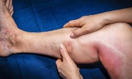 Chronic venous disorder may increase risk of venous thromboembolic events and mortality: Study