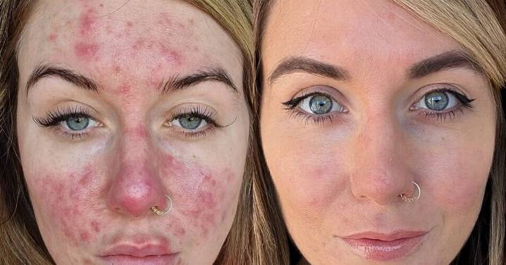 'My skin condition made me look like I was sunburnt