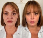 FOTO: El impresionante rejuvenecimiento facial que logró Gaby Spanic tras procedimiento estético en Brasil