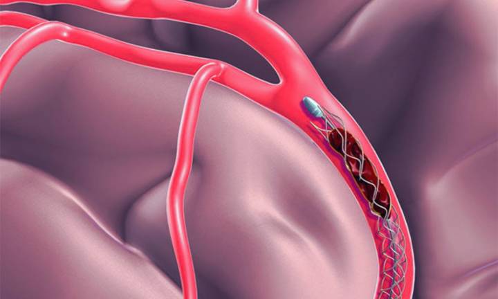 STORM-PE Trial: Mechanical Thrombectomy Shows Superior Heart Function Recovery in Pulmonary Embolism
