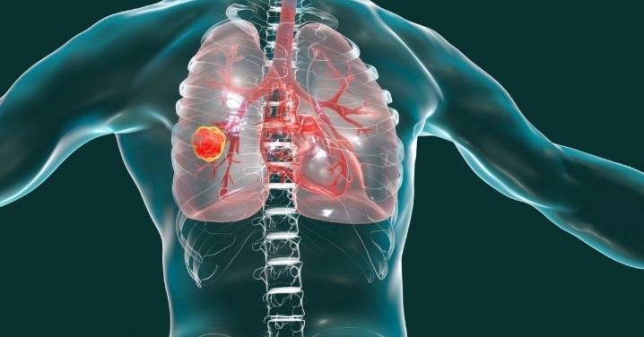 Descubiertos mecanismos metabólicos de resistencia al tratamiento del cáncer