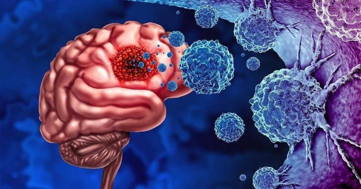 Traces Of Bacteria Found In Brain Tumors