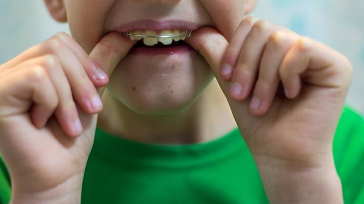 Bruxismo infantil: causas, consecuencias y el impacto del estrés en niños